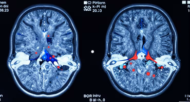 Neuroimaging